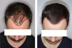 tecnica para recuperar cabello