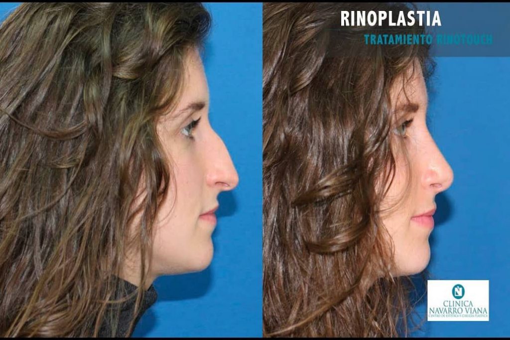 rinoplastia rinotouch