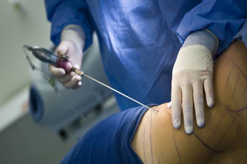 liposuccion