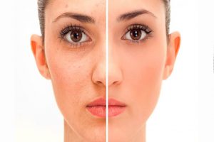 rejuvenecmiento-facial