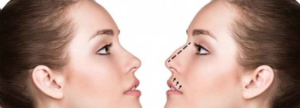 que es la rinoplastia