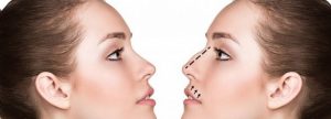que es la rinoplastia