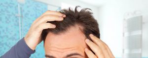 5 razones tratamiento celular alopecia