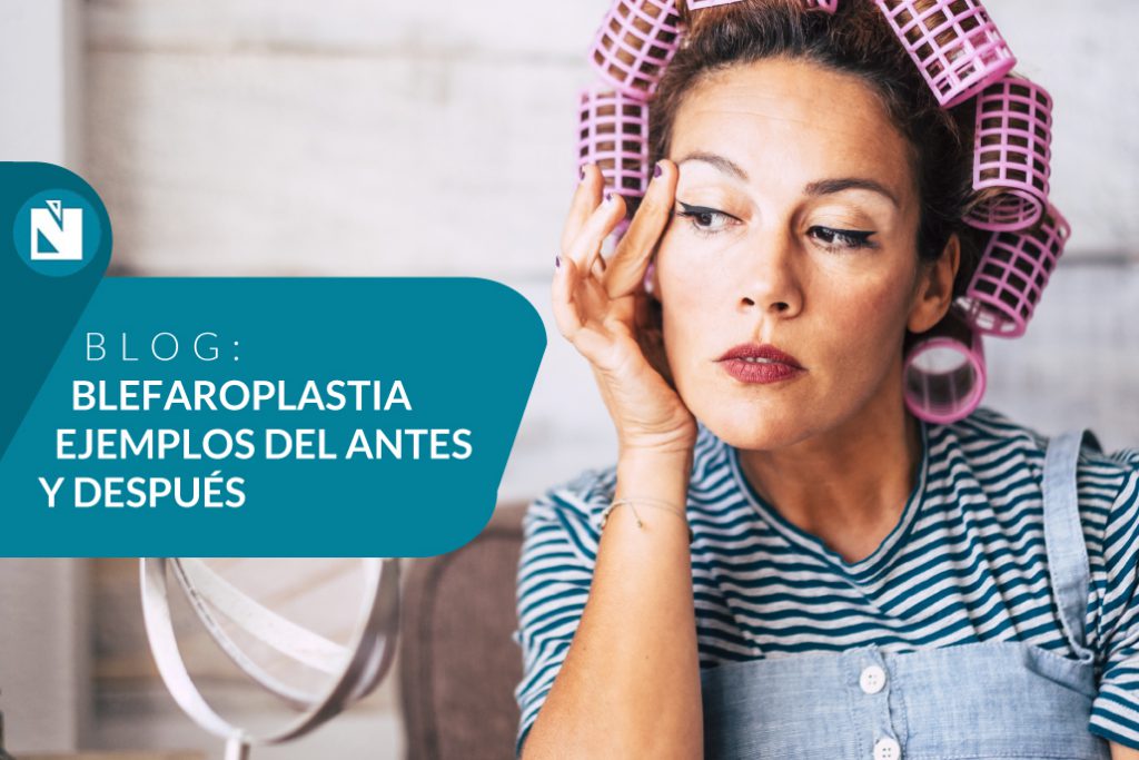 blefaroplastia antes y después