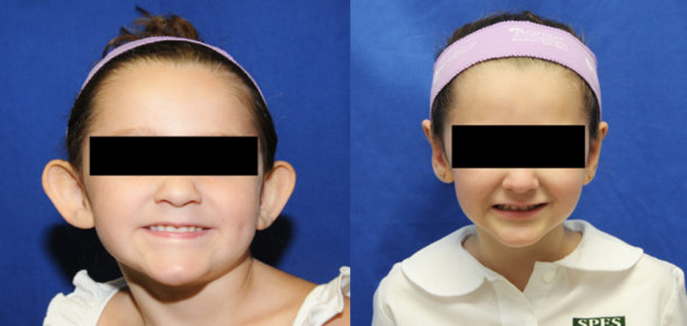 Otoplastia-antes-y-despues-valencia-1