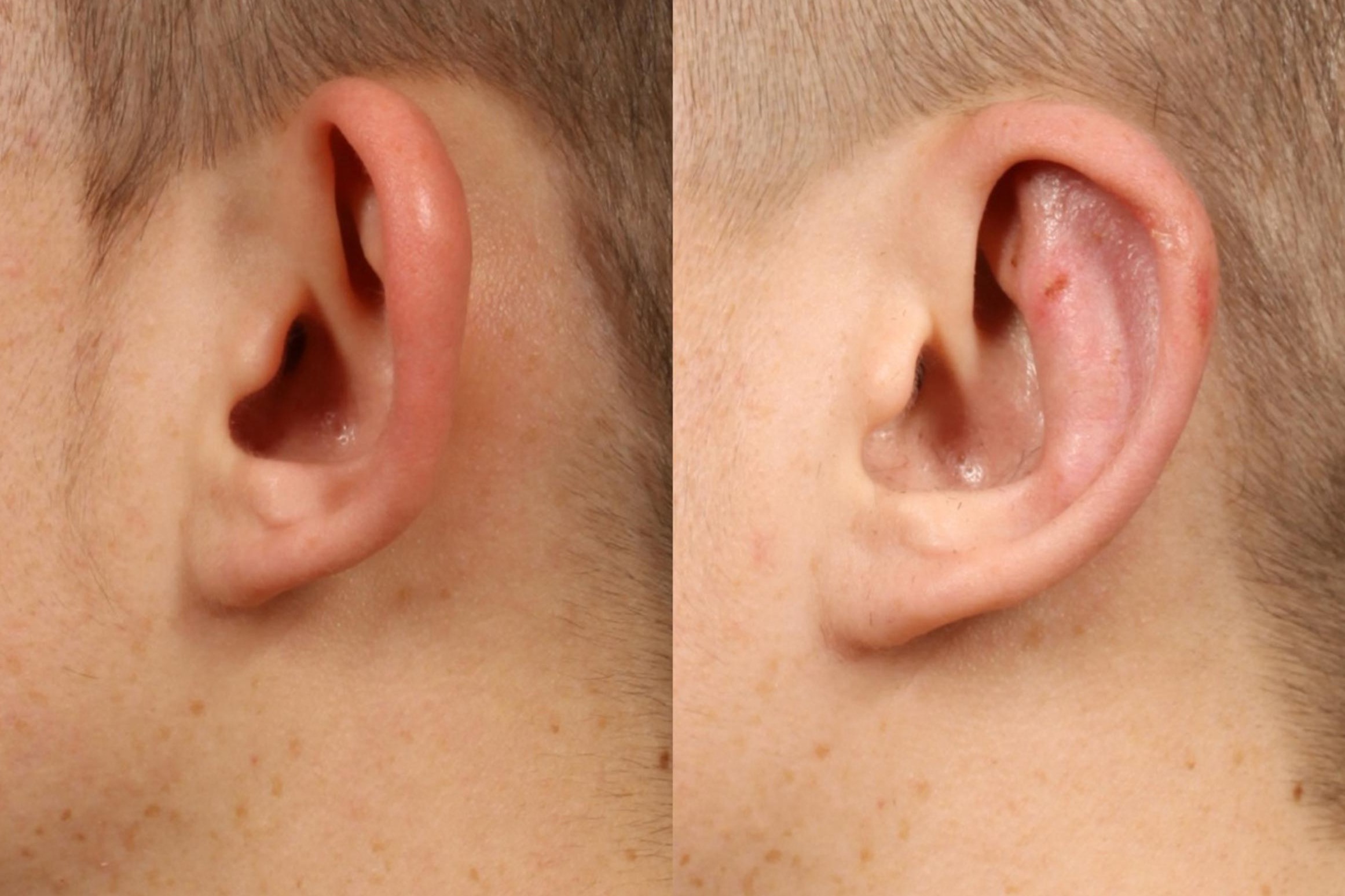 otoplastia-3