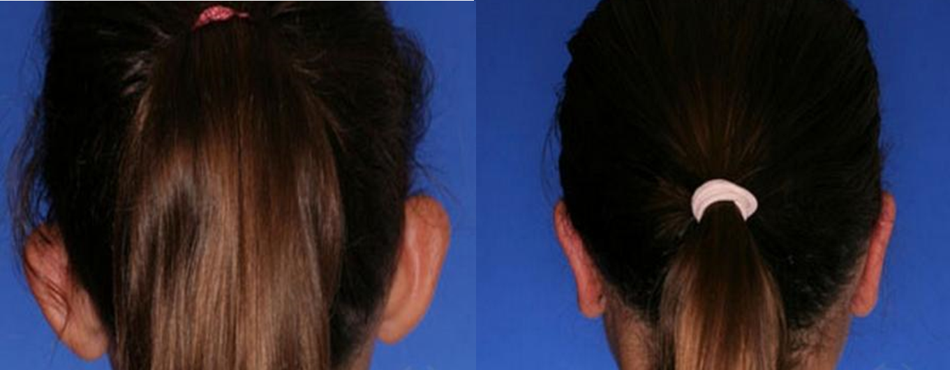 otoplastia-6