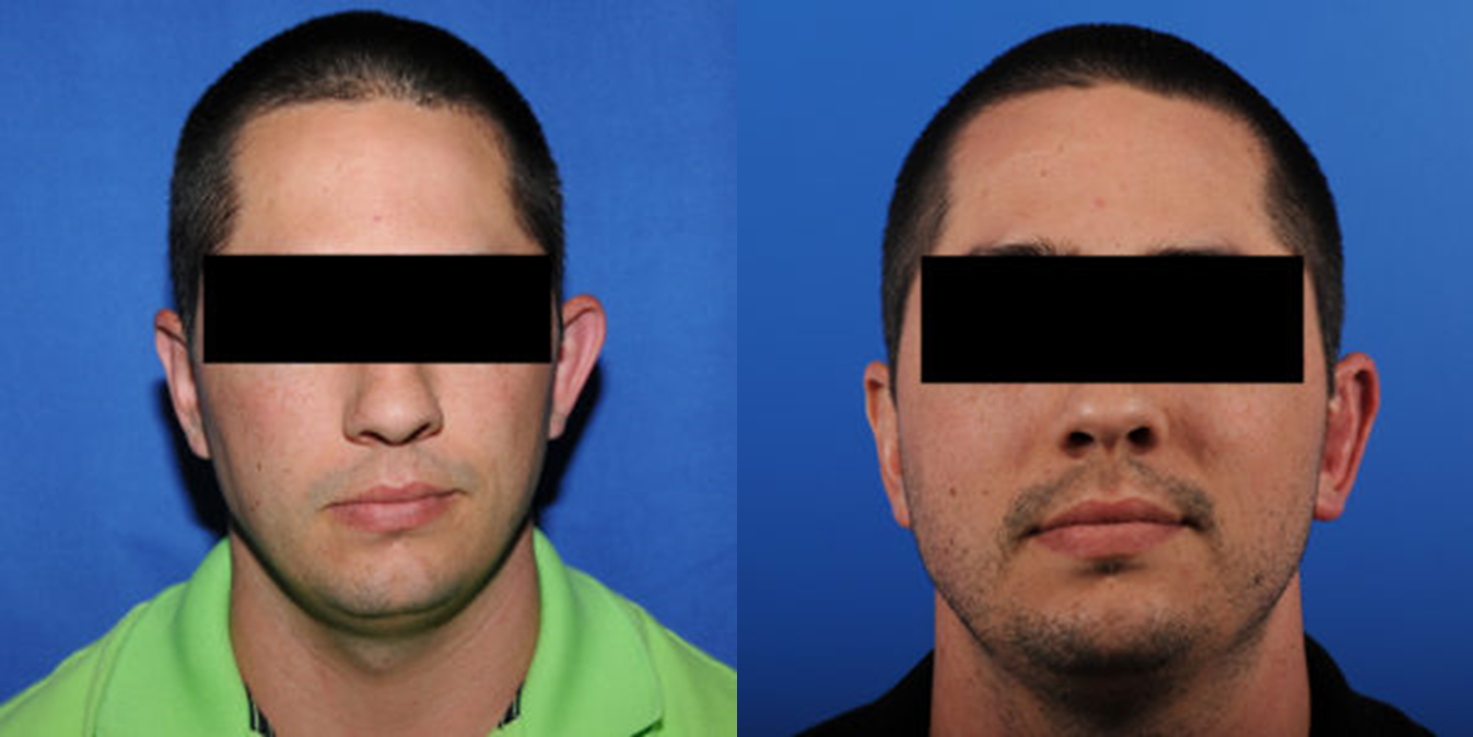 otoplastia-antes-y-despues-valencia-2