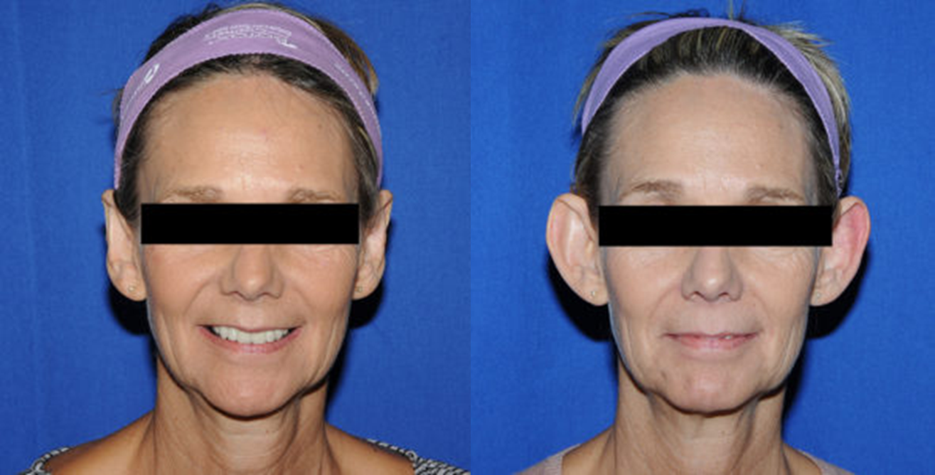 otoplastia-antes-y-despues-valencia-3