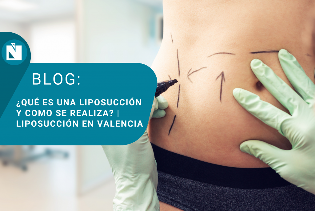 liposuccion en valencia