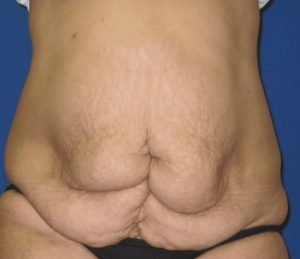 abdominoplastia1