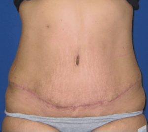 abdominoplastia2
