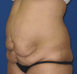 abdominoplastia3