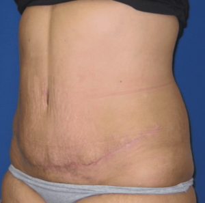 abdominoplastia4