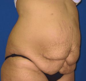 abdominoplastia5