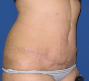 abdominoplastia6