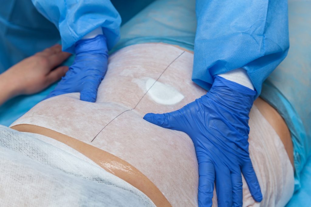postoperatorio abdominoplastia