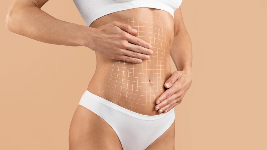 Resultados de una abdominoplastia