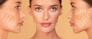 Lifting cervico facial