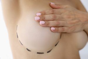 mamoplastia