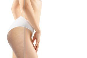 tratamientos para la celulitis