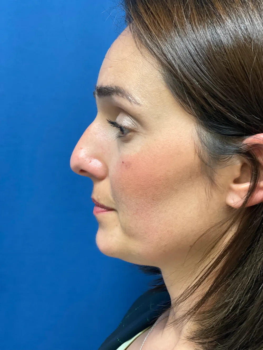 rinoplastia-valencia