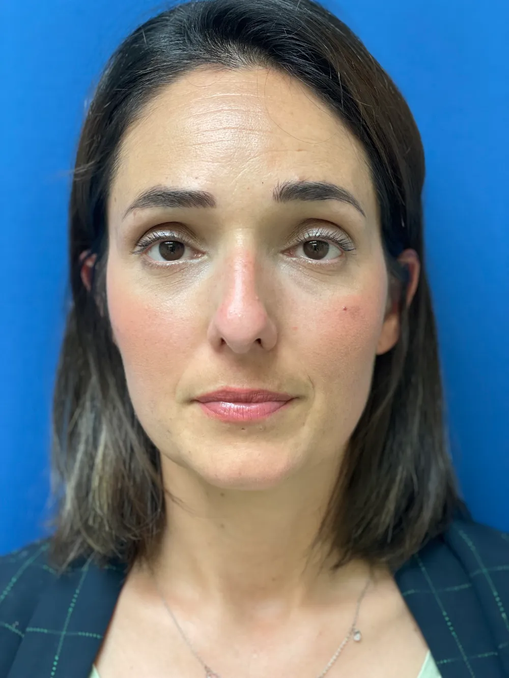 rinoplastia-antes y despues valencia