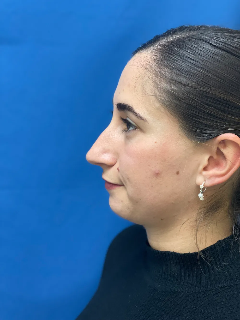 rinoplastia-antes y despues valencia