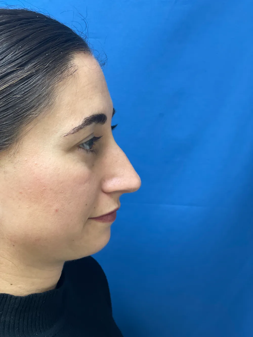 rinoplastia-antes y despues valencia