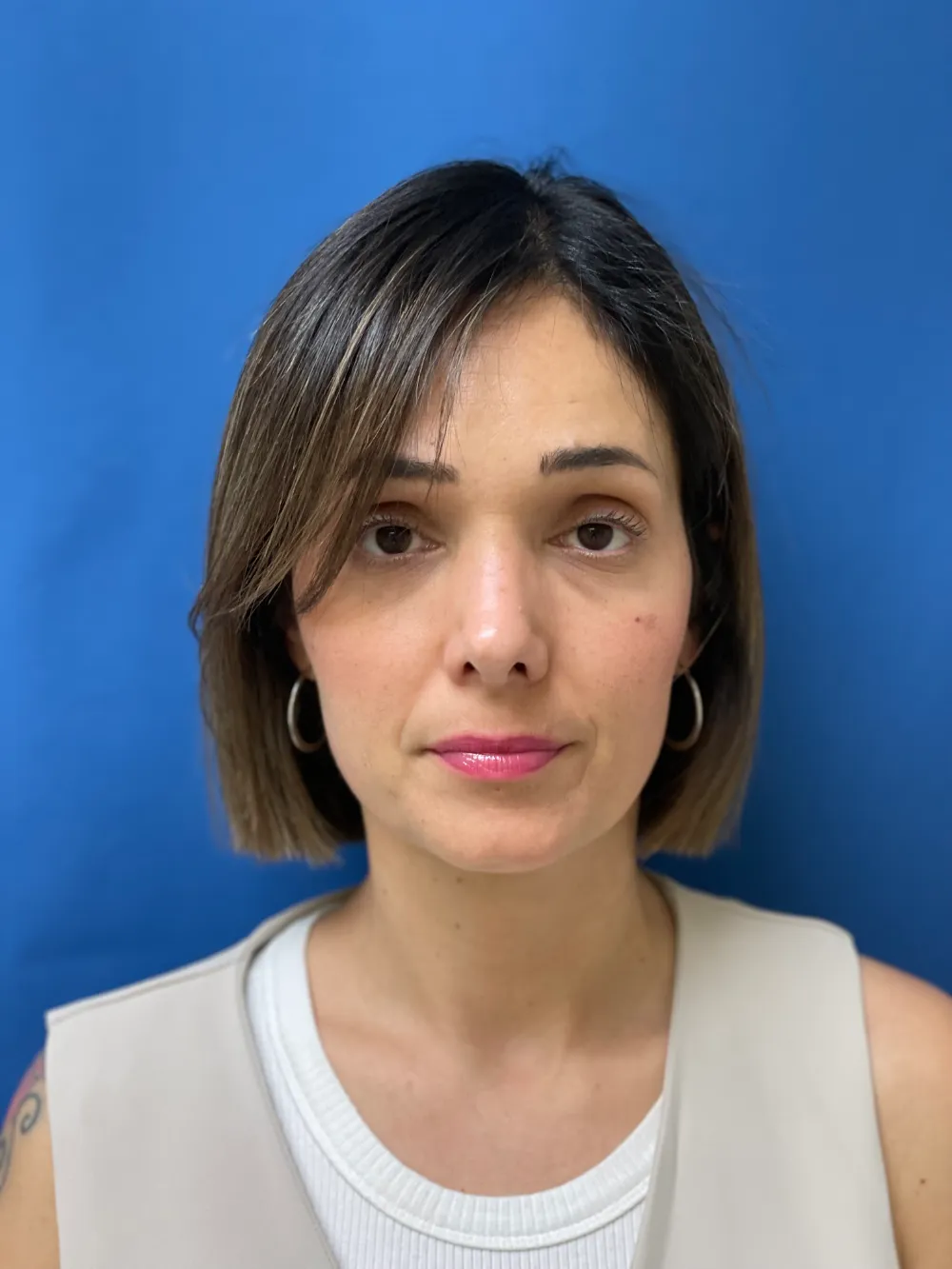 rinoplastia-antes y despues valencia