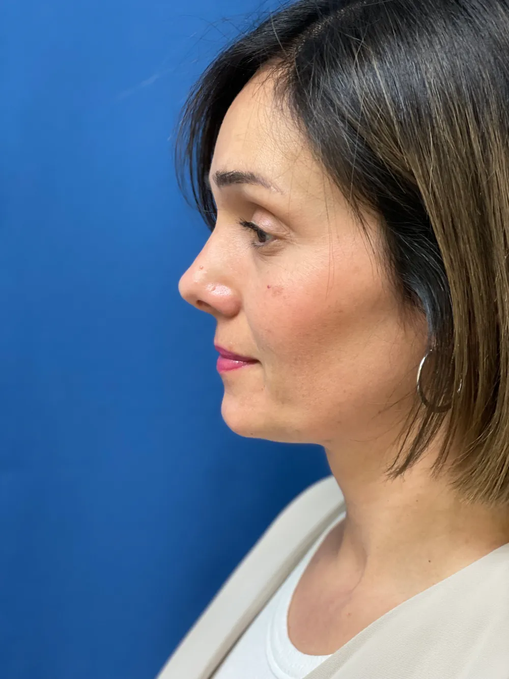 rinoplastia-antes y despues valencia