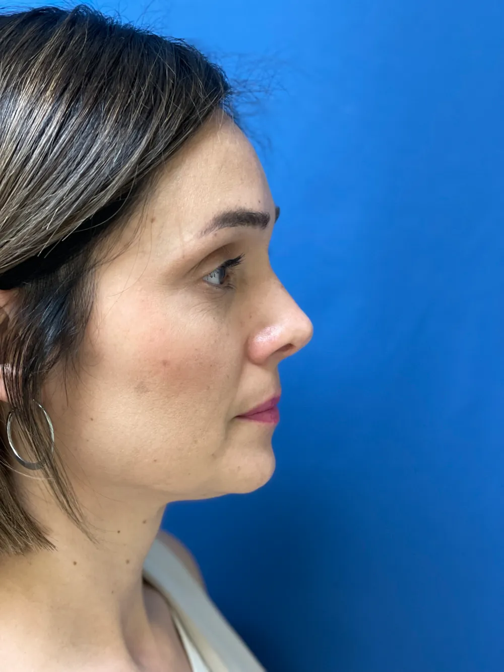 rinoplastia-antes y despues valencia