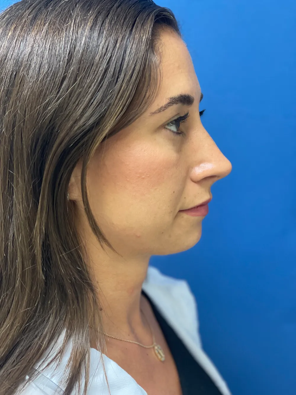 rinoplastia-antes y despues valencia