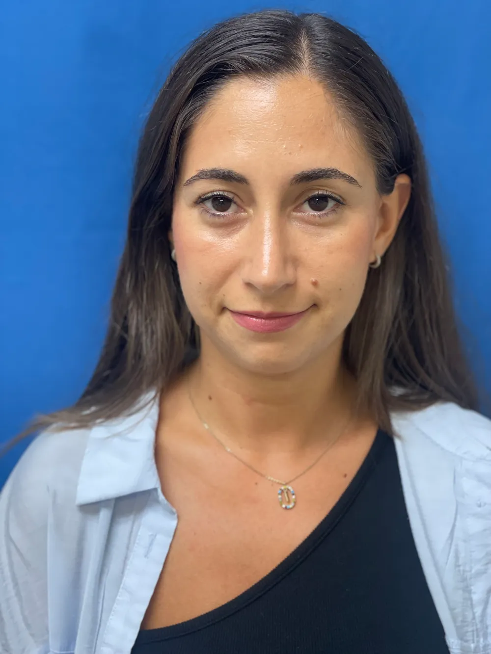 rinoplastia-antes y despues valencia